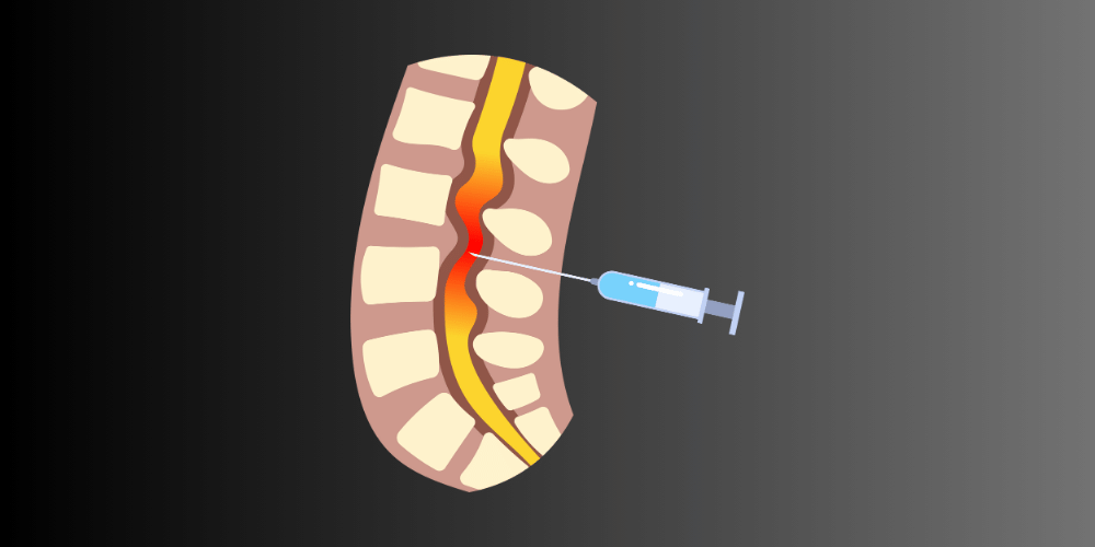Ankylosing Spondylitis