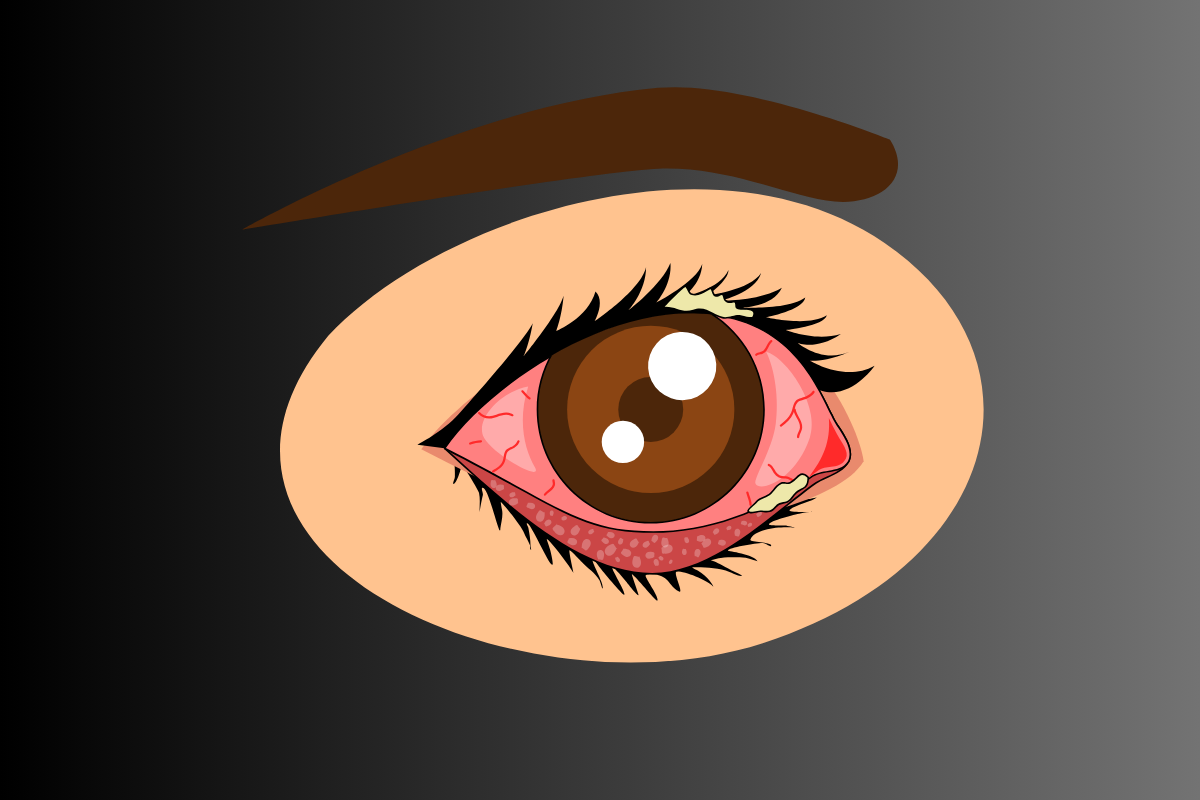 Burning and Itching in Eyes