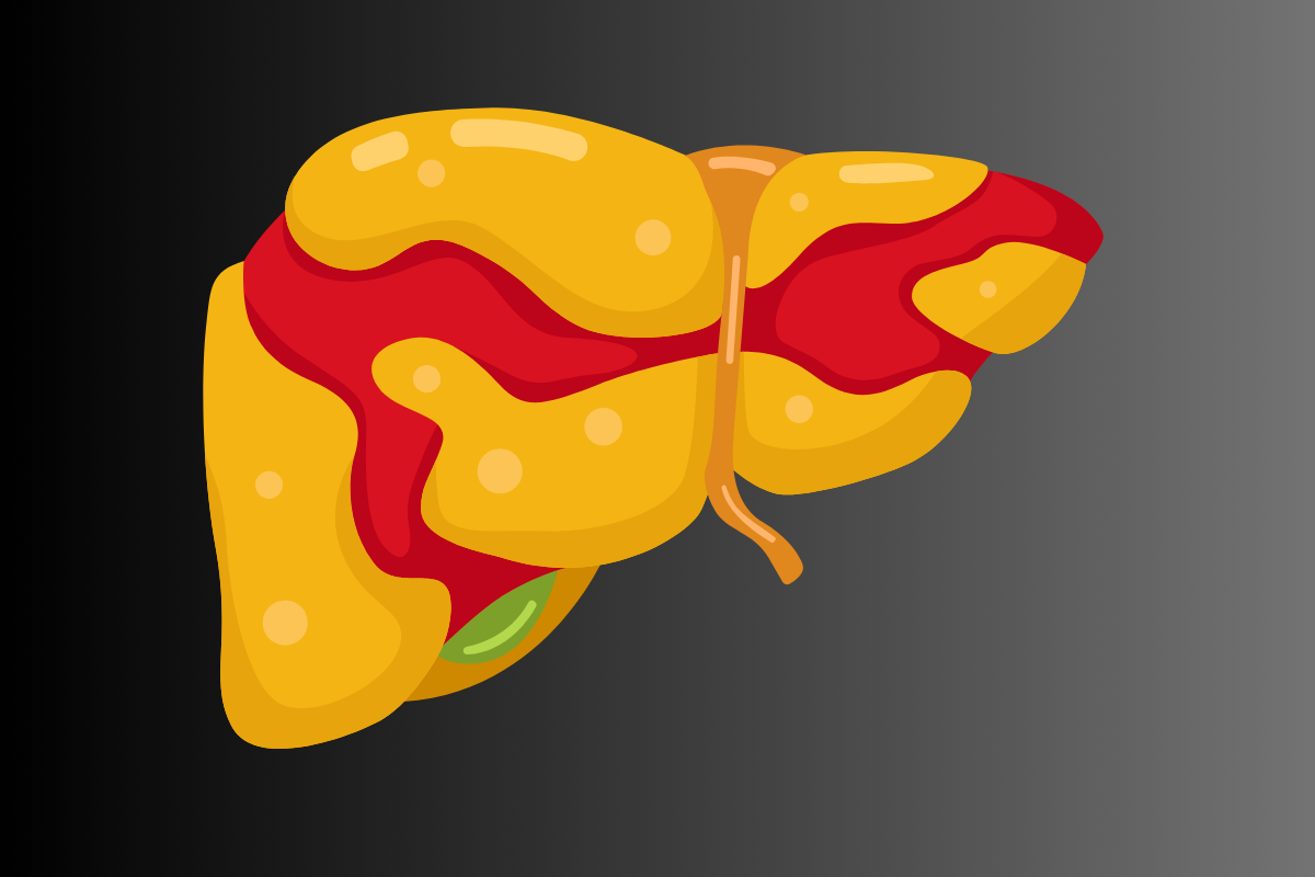 Fatty Liver