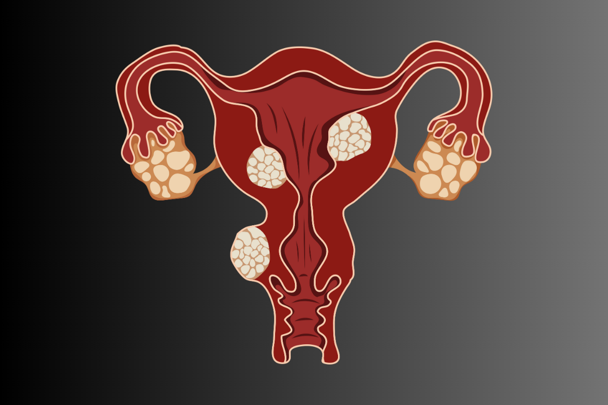 Fibroid