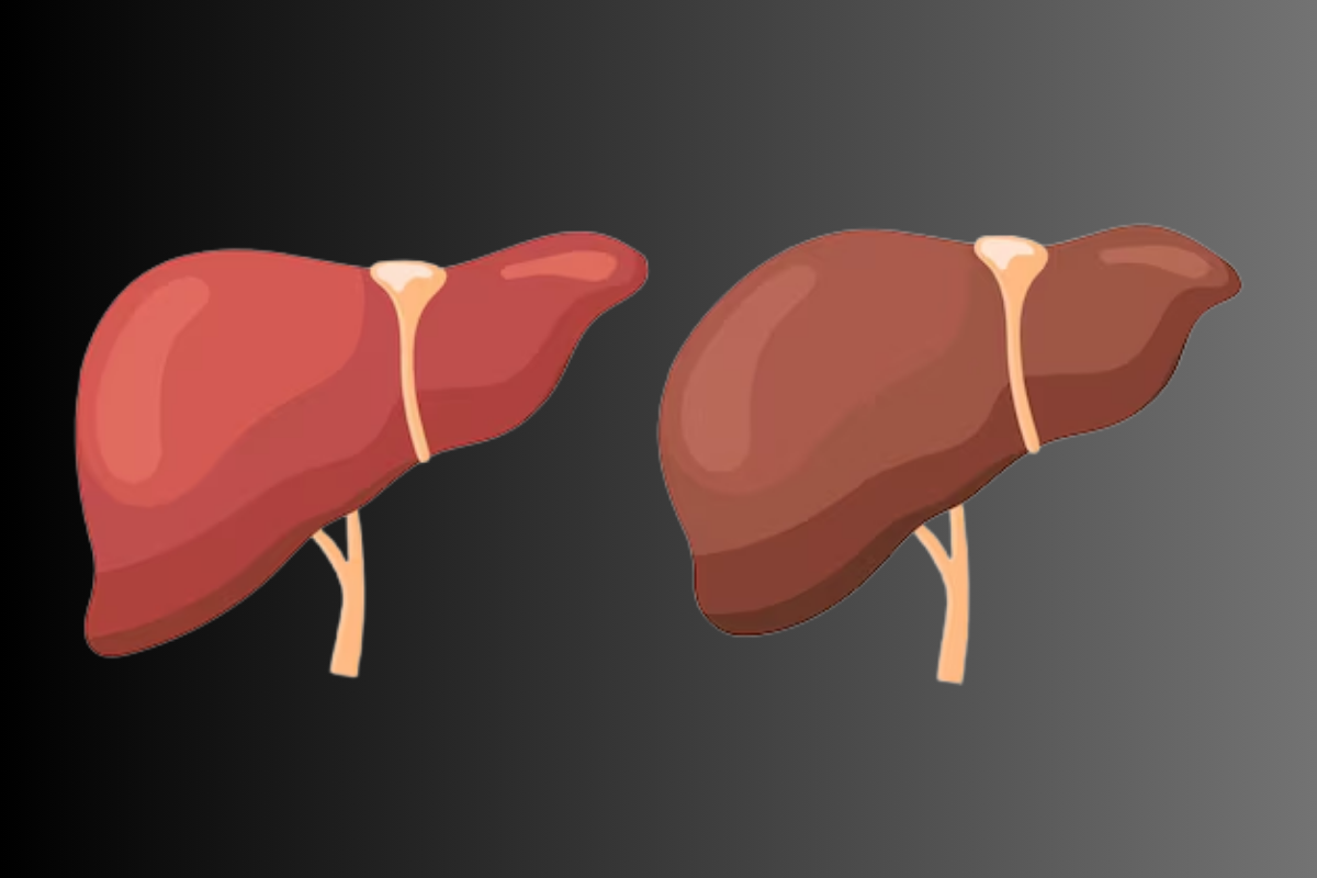 Liver Enlargement