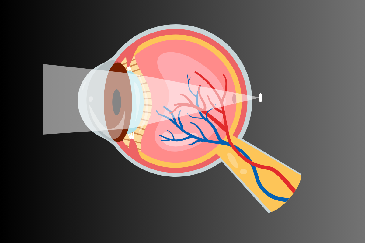 Myopia and Hypermetropia