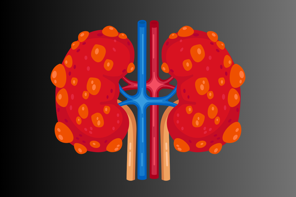 Polycystic Liver Disease
