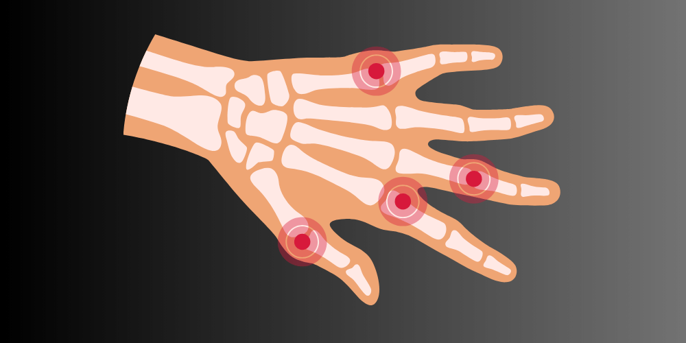 Rheumatoid Arthritis