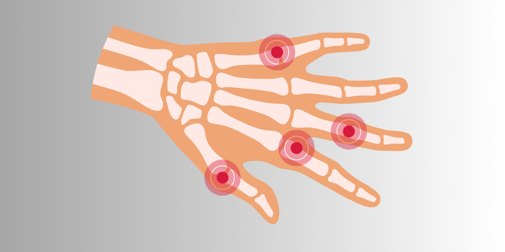 Rheumatoid Arthritis