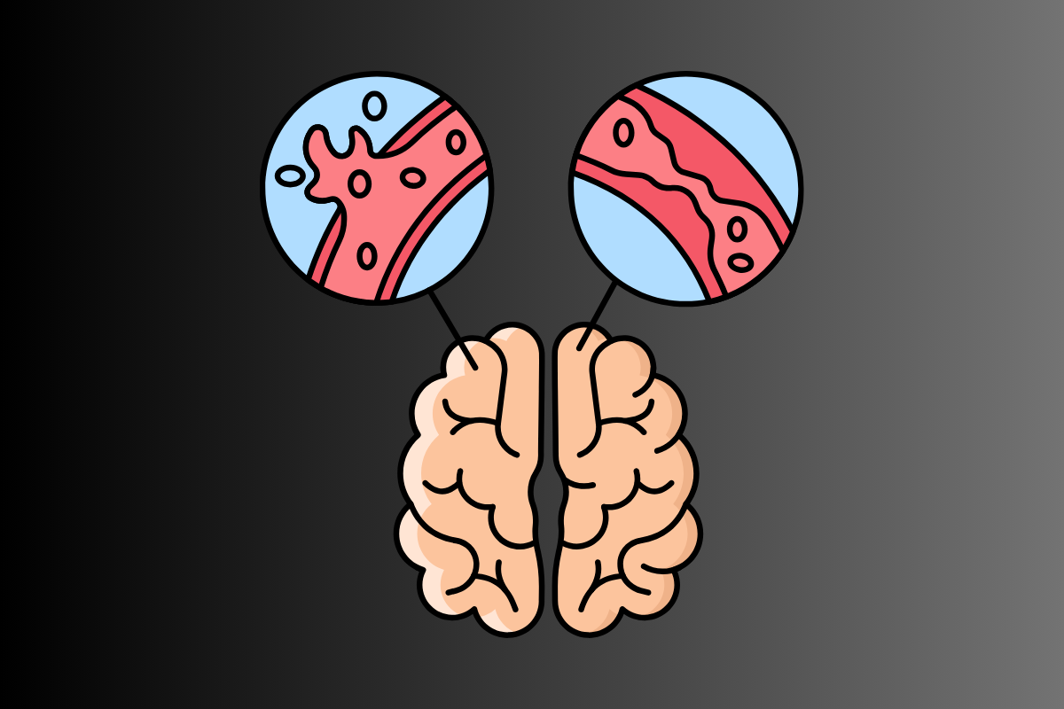 Stroke (Brain Attack)
